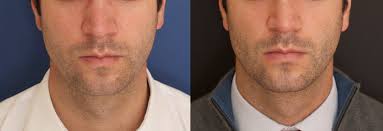 Bichectomy Before & After