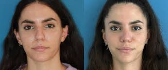 Mentoplasty Before & After