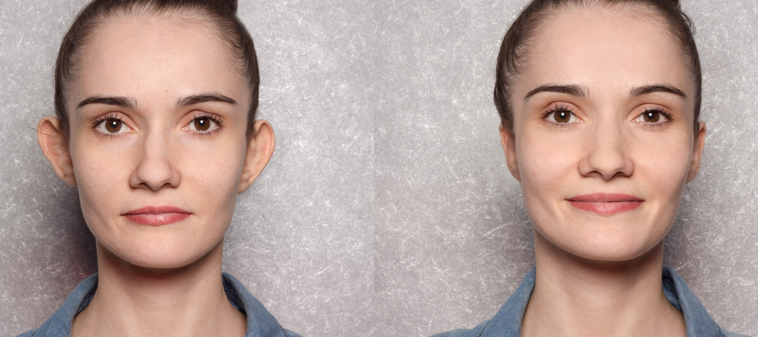 Otoplasty Before & After